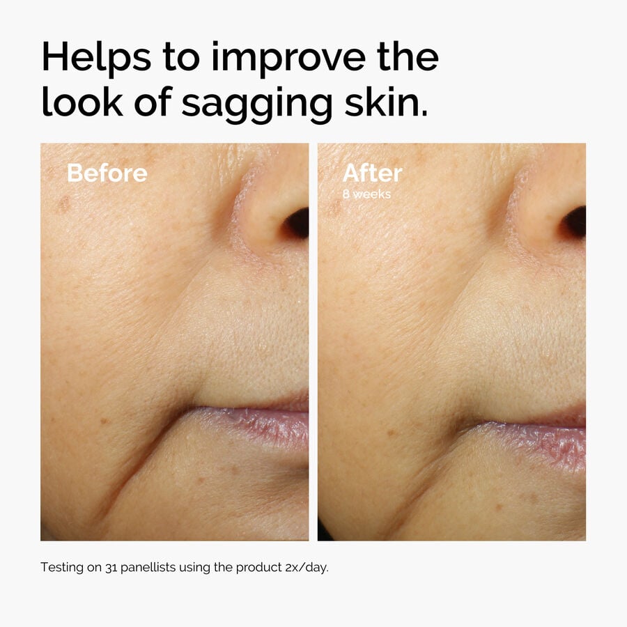 Before and after comparison showing improvements in the look of sagging skin. After 8 weeks of using Caffeine 3% + Escin 1% Face Serum twice daily, the appearance of skin laxity is visibly reduced.